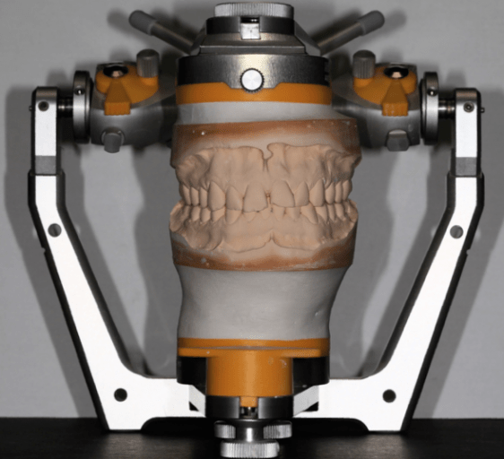 Benefits and Reasons To Complete a Diagnostic WaxUp Spear Education