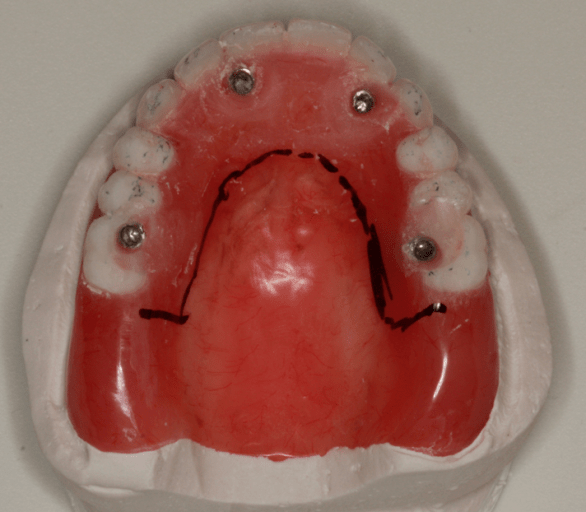 A StepbyStep Guide to Converting Denture to Interim Hybrid Prosthesis