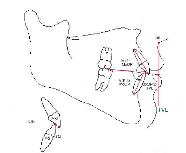 Ideal Position of Central Incisor Using Facially Generated Treatment