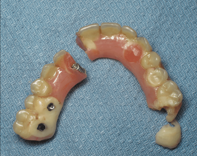 Fixed Dental Prosthesis