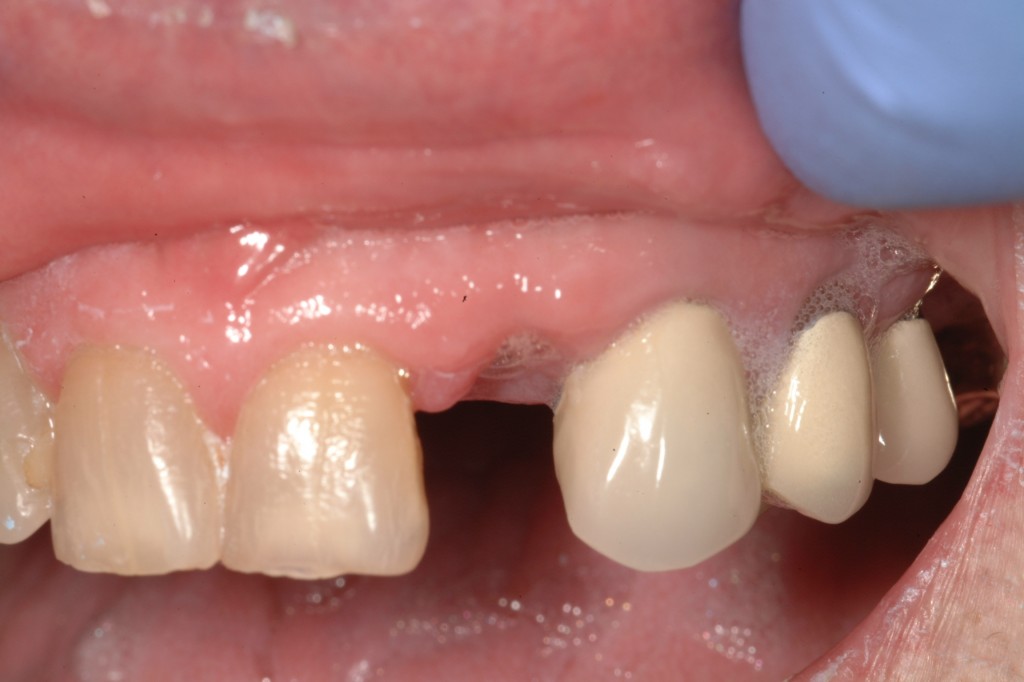 Ovate Pontic Maryland Bridges for Implant Temporaries Spear Education