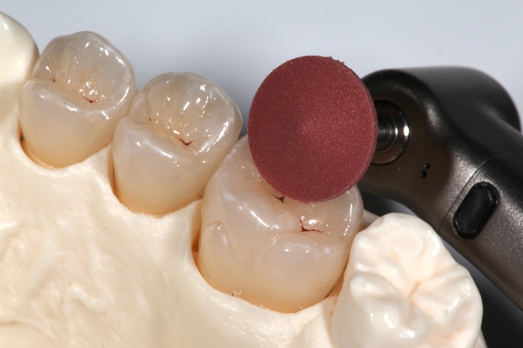 Clinical Tips for Polishing Ceramics e.max and Zirconia Spear Education
