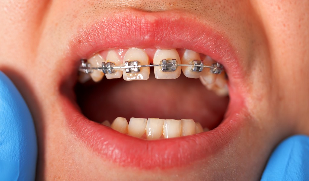 Transferring Retention for Dental Patients with Problem Retention