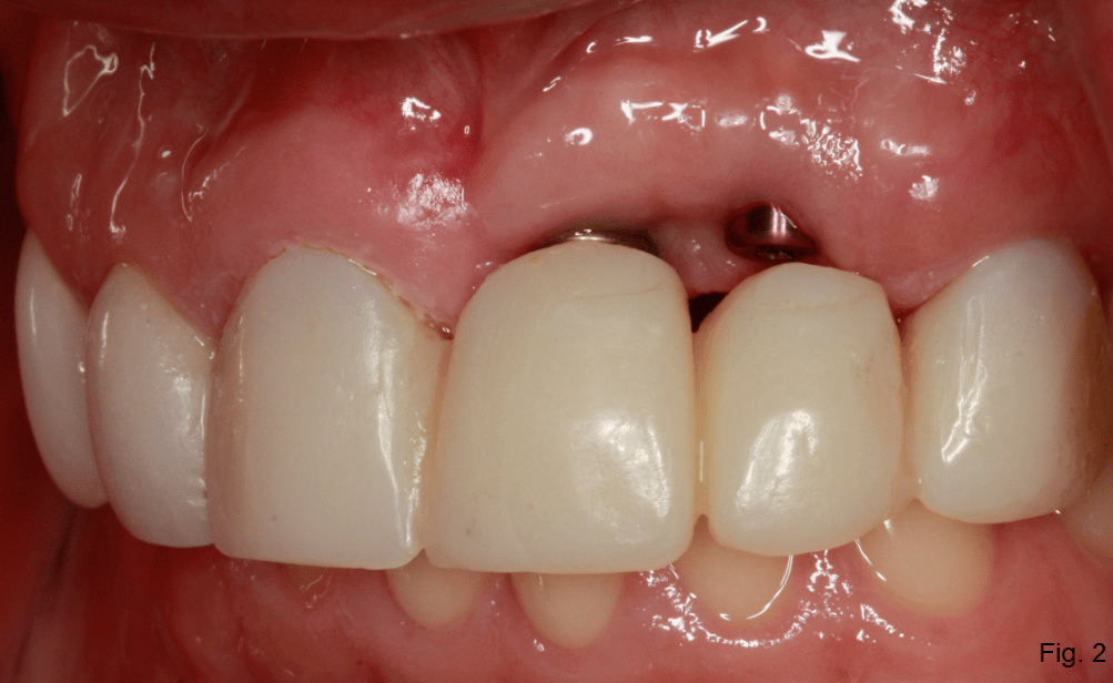 Implant Supported Fixed Bridge for Maxillary Incisors Spear Education