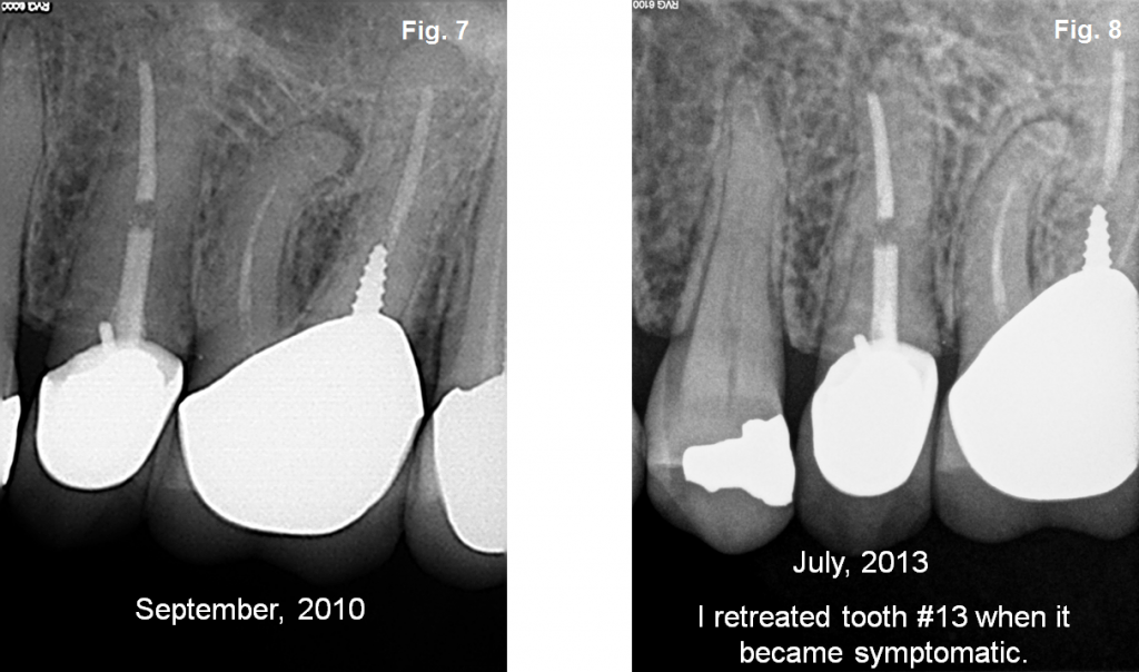 Endodontics Advocating Smaller Canal Preps Spear Education