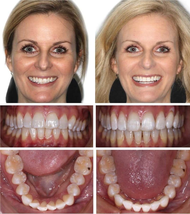 Invisalign in Platte City , Gladstone , Parkville , Invisalign in