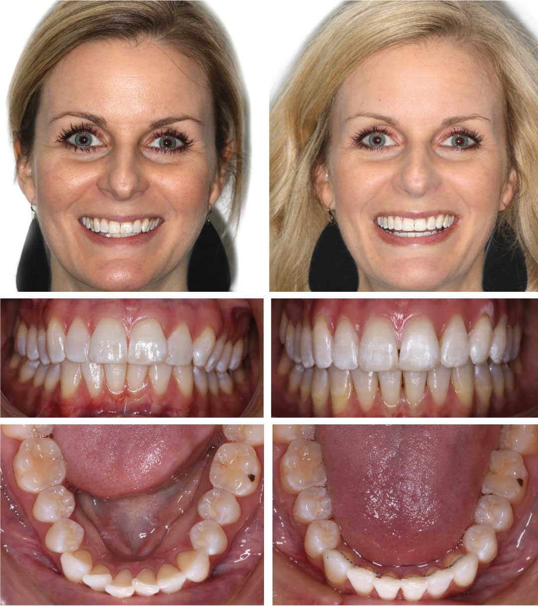 Invisalign in Platte City , Gladstone , Parkville