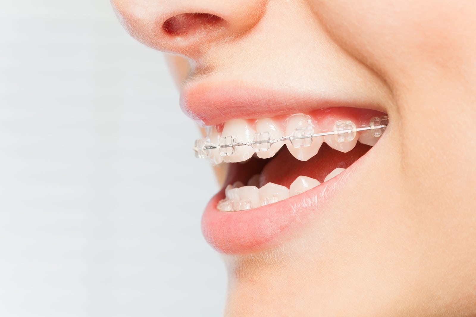 Blog Mansfield Orthodontics