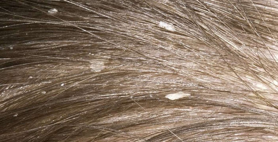 How to Identify Nits