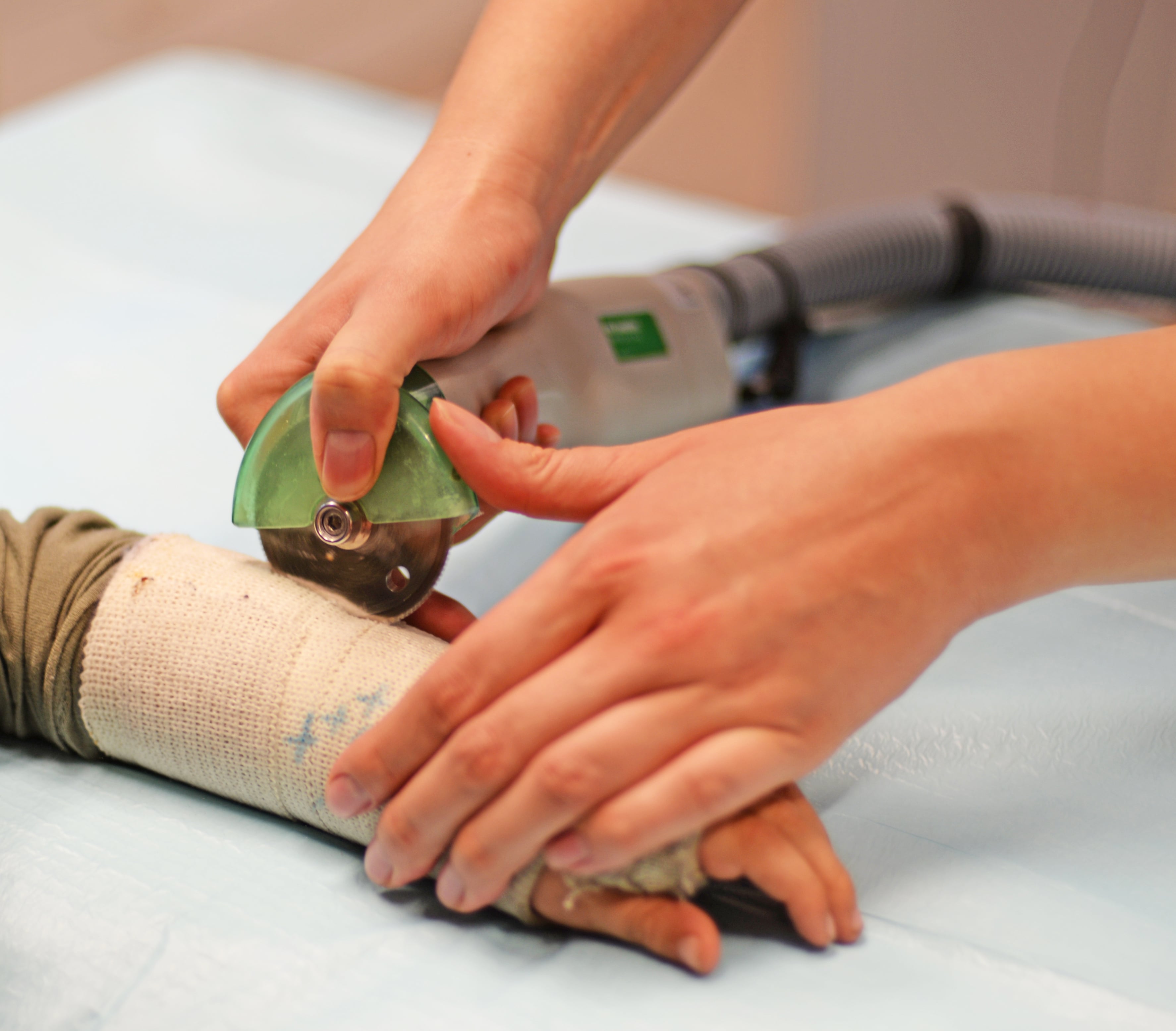 How Plaster Casts are Used to Treat Fractures