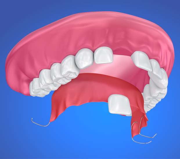 Partial Denture for One Missing Tooth Palm Desert, CA Portola Dental