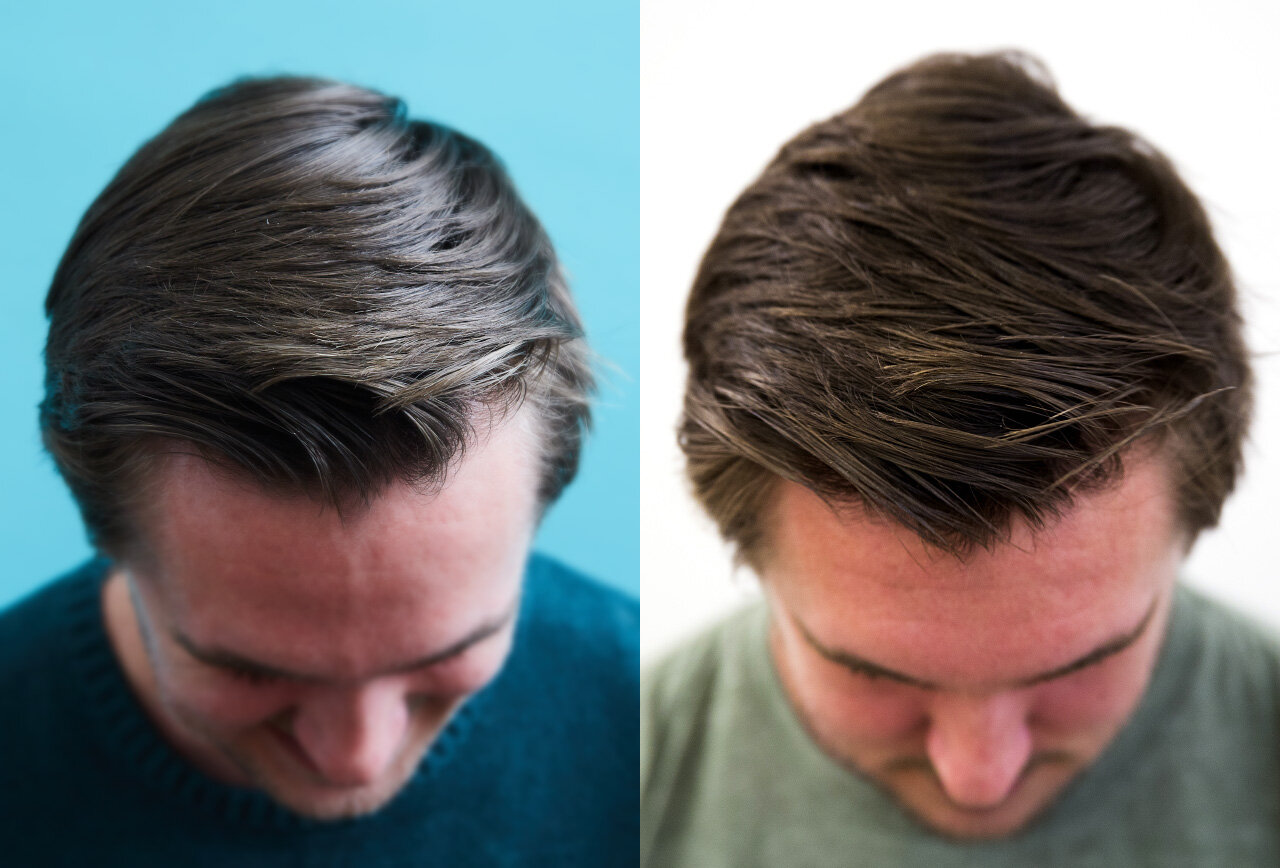 Does Alcohol Cause Dandruff?