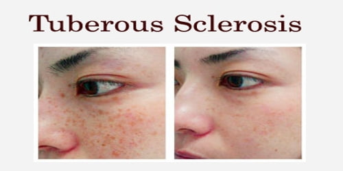 Tuberous Sclerosis Skin Symptoms Lilianaescaner
