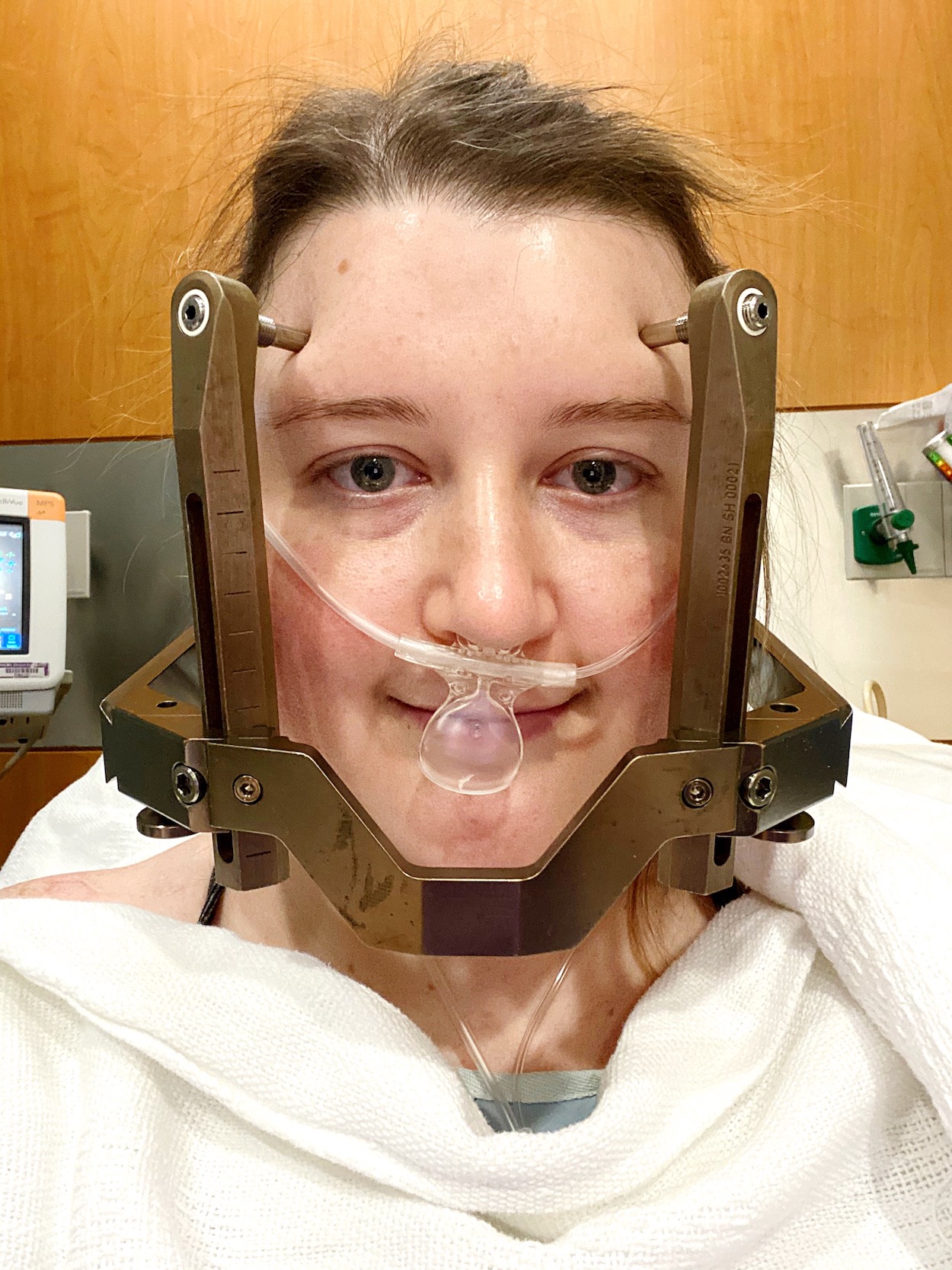 Stereotactic Radiosurgery Procedure As Told By Ash and Shelbs