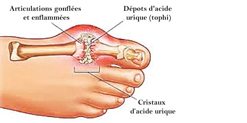 Comment contrôler les niveaux d’acide urique de 10 manières différentes