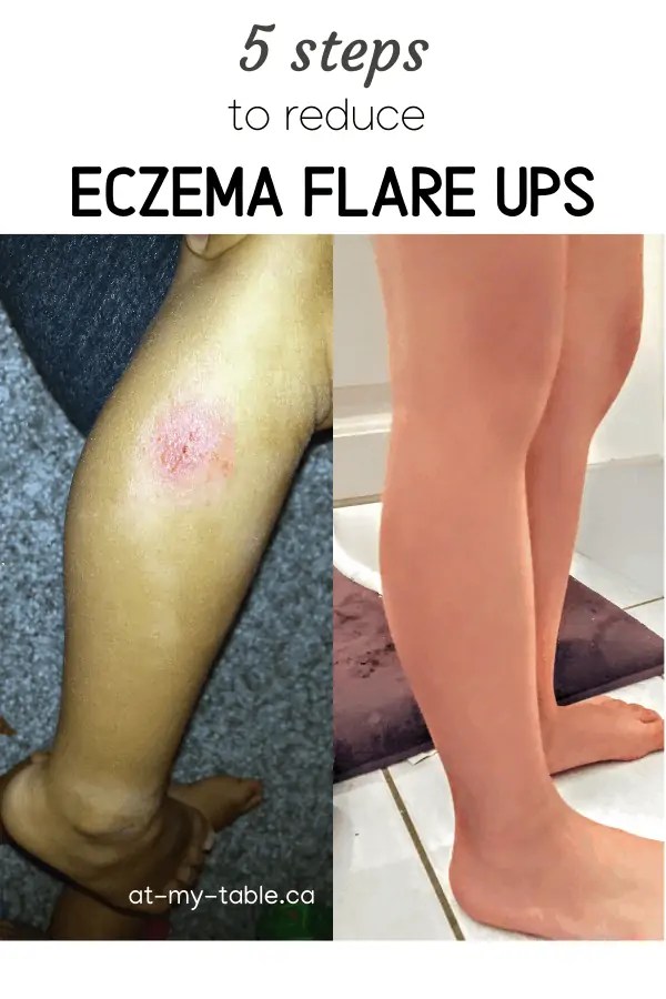 How to prevent eczema flare ups, 5 steps AtMyTable