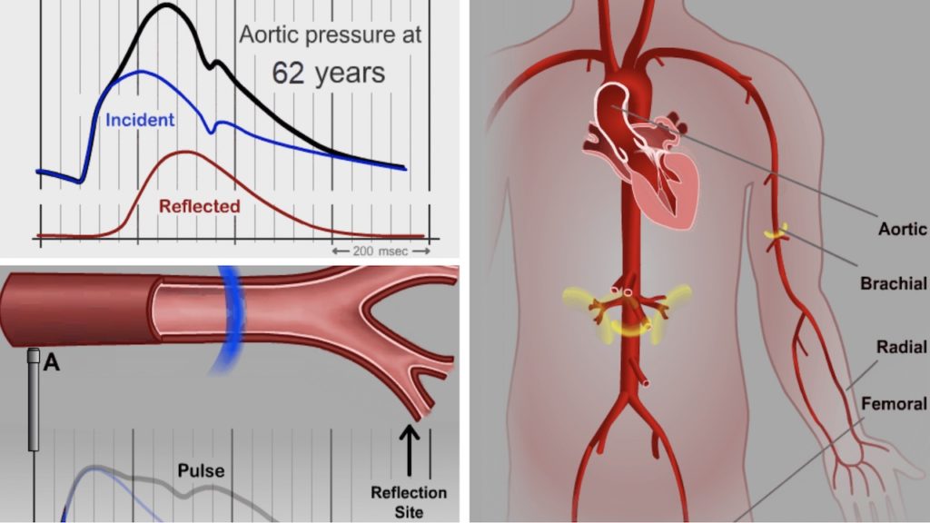 Noninvasive Central Aortic Blood Pressure ATCOR