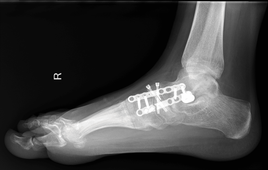 Kohler's Disease Case Report Treatment with Regenerative Distraction