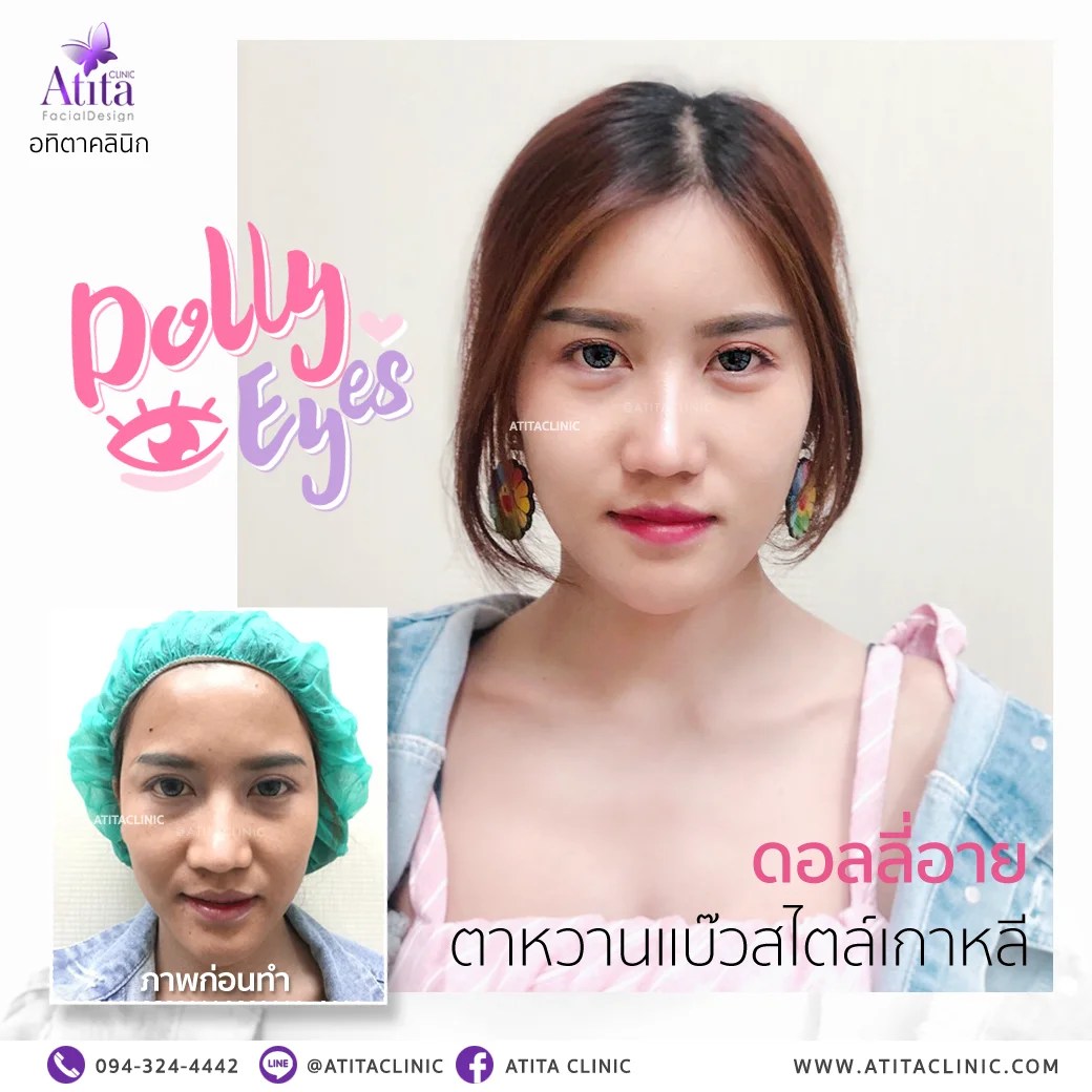 รีวิว Dolly eyes Atita Clinic