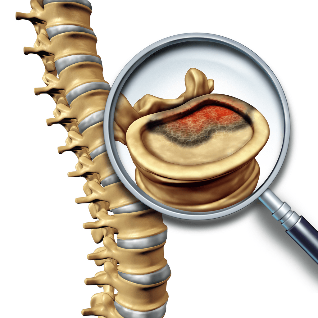 Benign Spinal Tumors Atlanta Brain and Spine Care