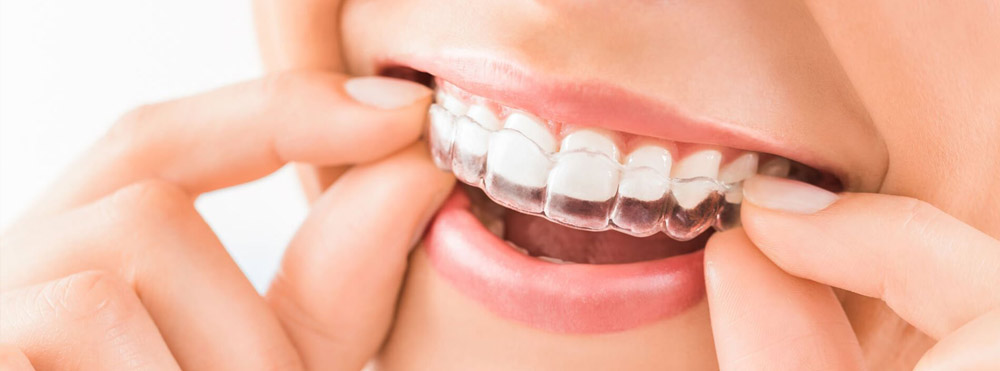 How Old Does My Child Have to be to Start Invisalign?