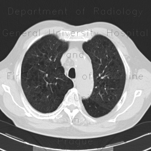 Radiology case Panlobular emphysema