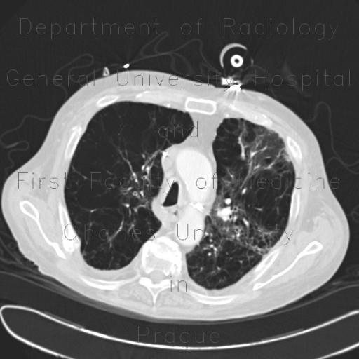 Radiology case Panlobular emphysema