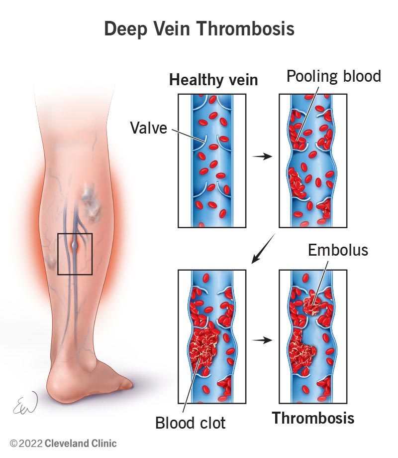 Comprehensive Guide to Deep Vein Thrombosis (DVT) Atlas Pain Specialists