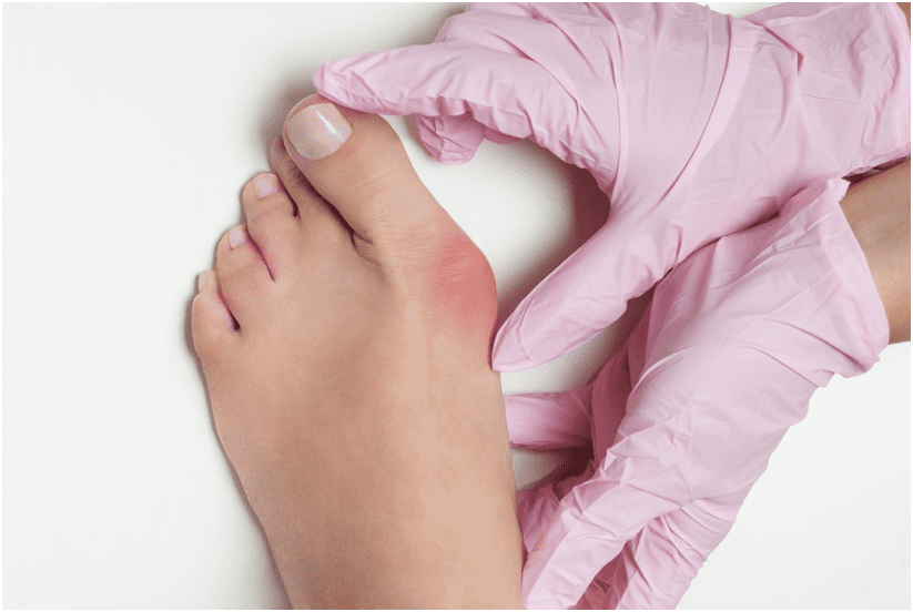 Non Surgical Bunion Treatment Treatment for Bunions on Big Toe
