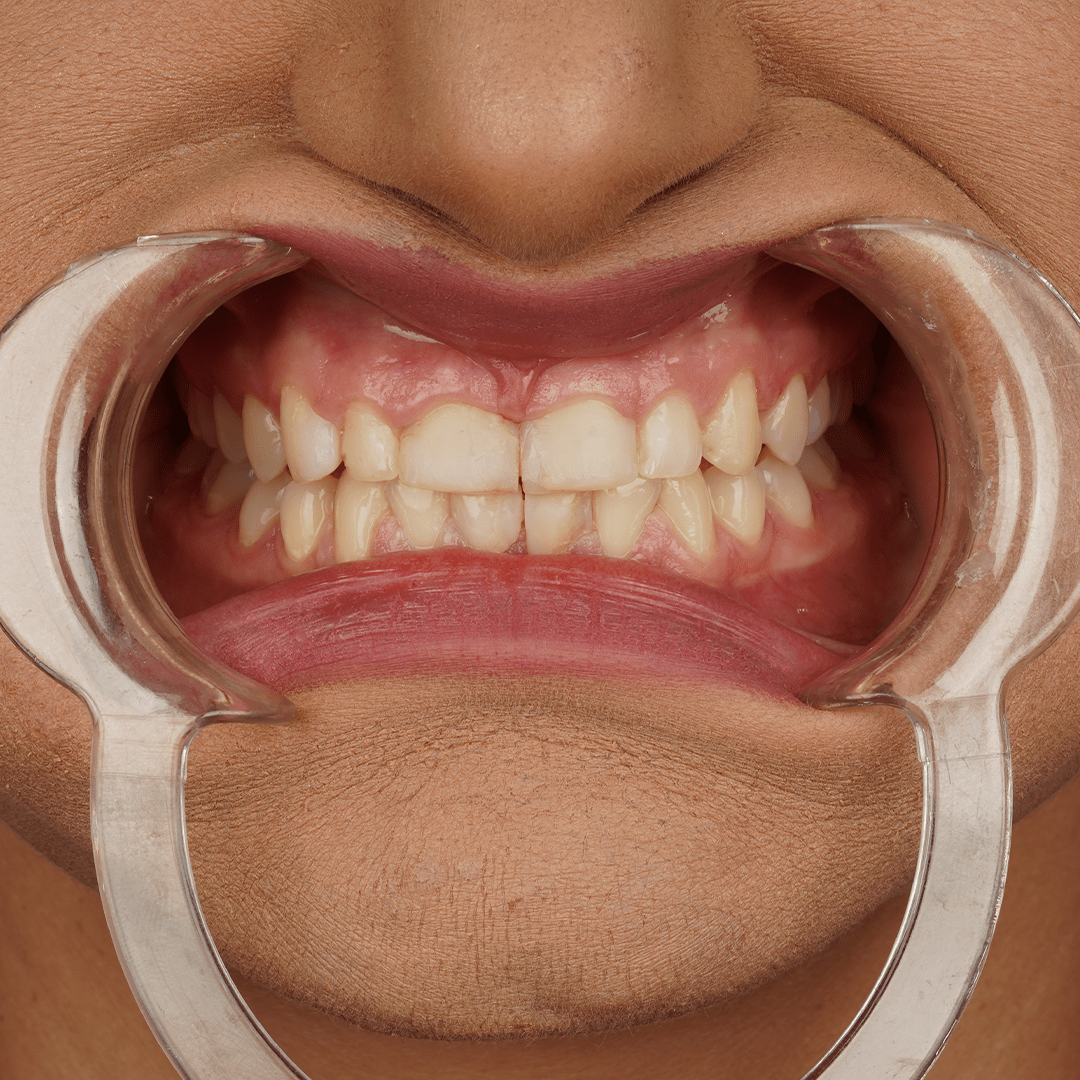 Laminate Veneers ATOM Clinic