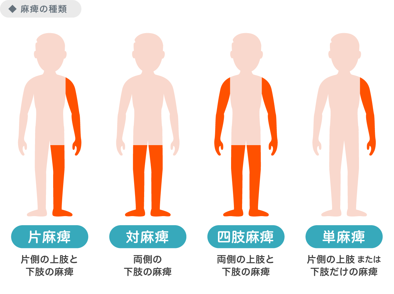 交通事故での脊髄損傷の後遺症｜治療法・リハビリ・後遺障害慰謝料・示談金・賠償などを解説｜交通事故の弁護士カタログ