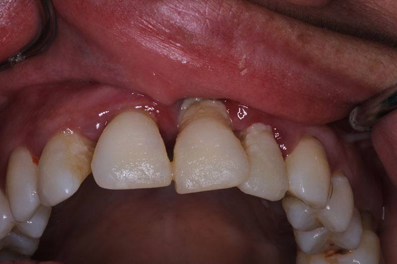 Best All On 4 Dentures in Chicago All On Four Dental