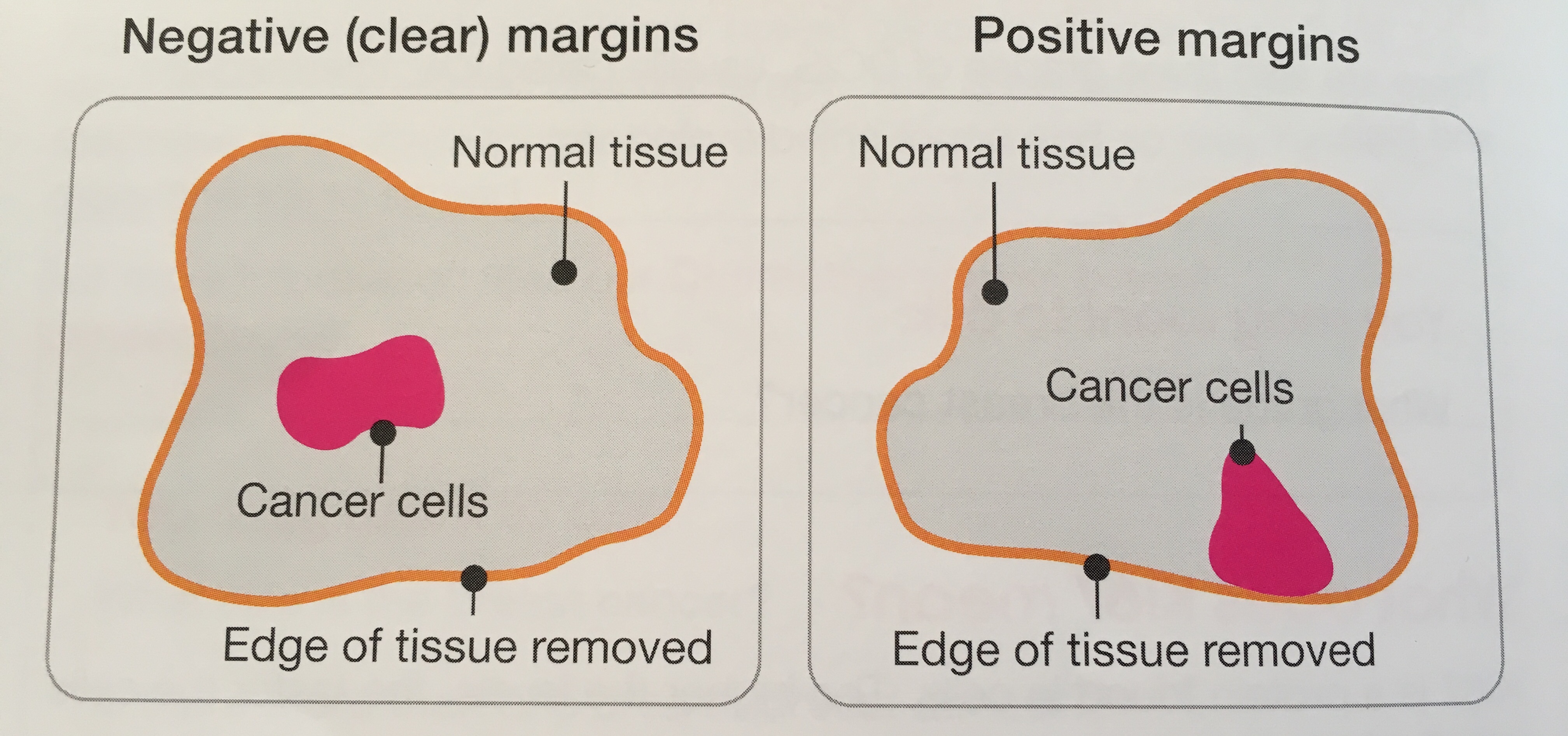 The A to Zee of BC Page 2 Battling breast cancer one letter at a time