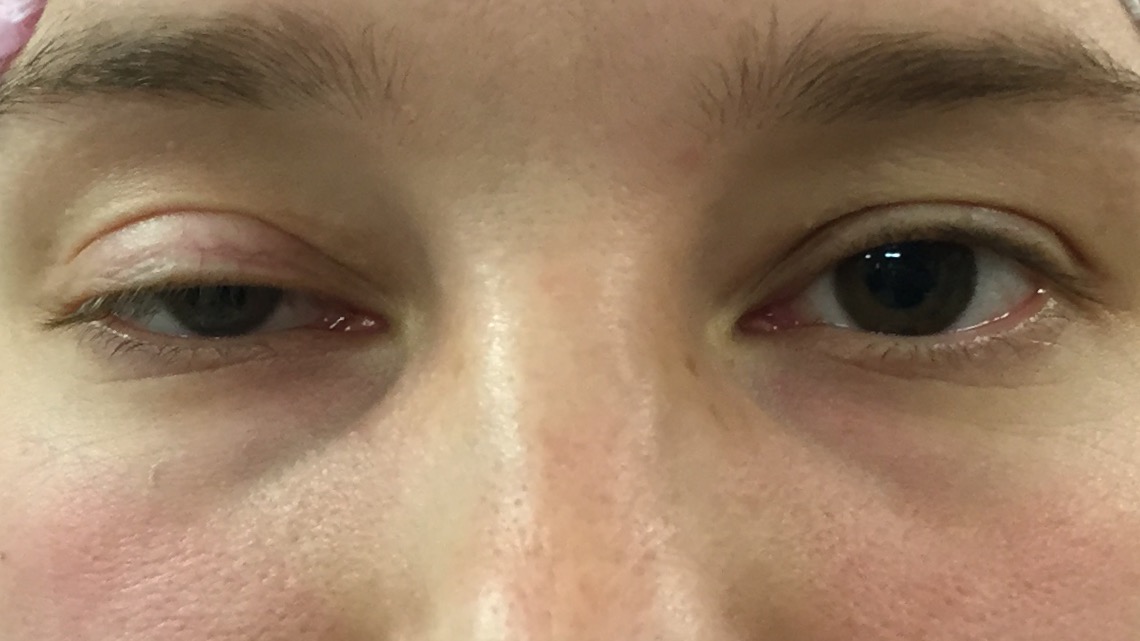 Ptosis vorher www.augenmedizin.at