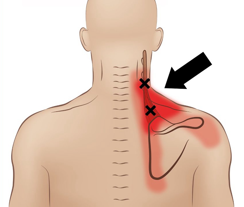 Kinesiology Tape Shoulder Scapula Pain AC joint pain