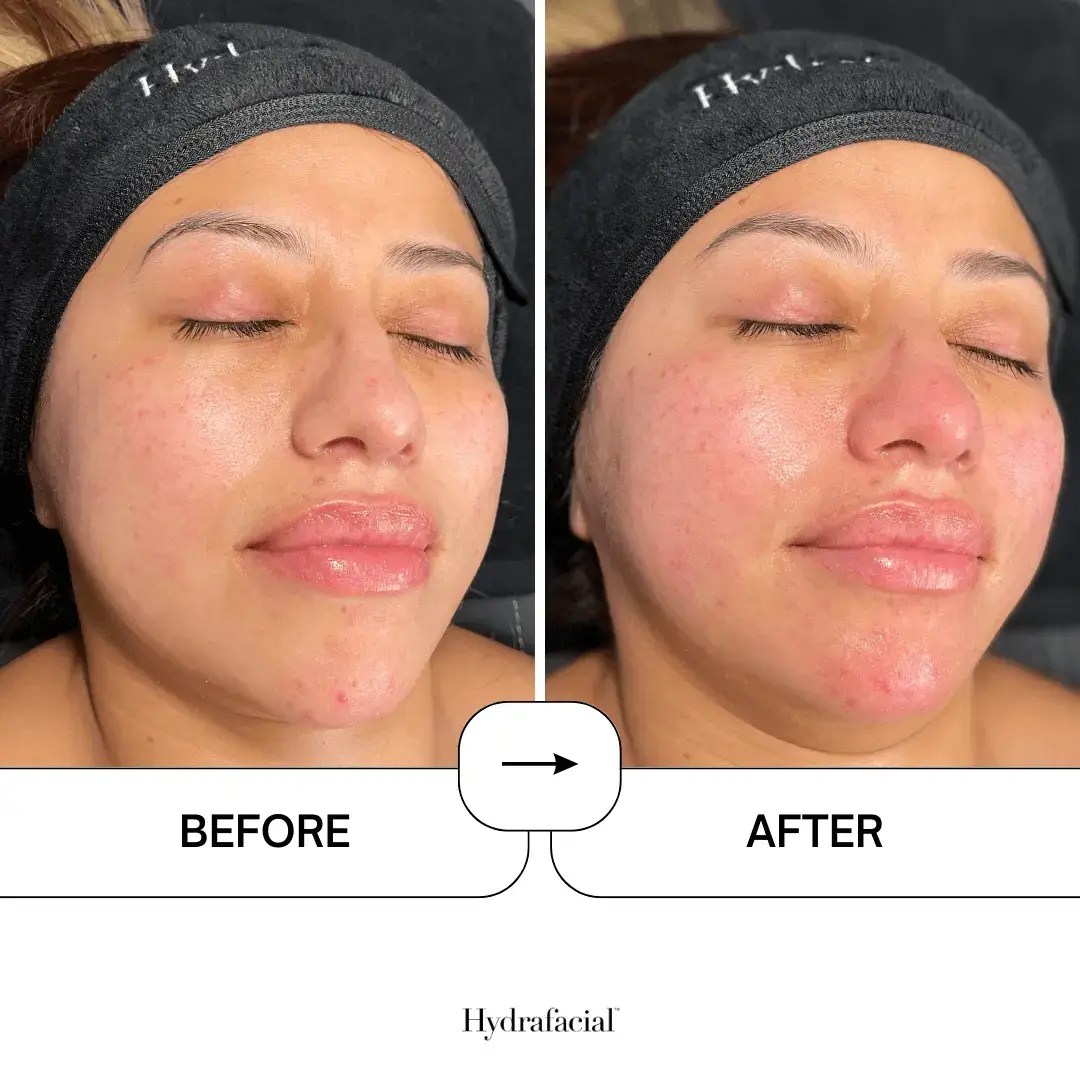 HydraFacial in Kent, Rochester HydraFacial Near Me