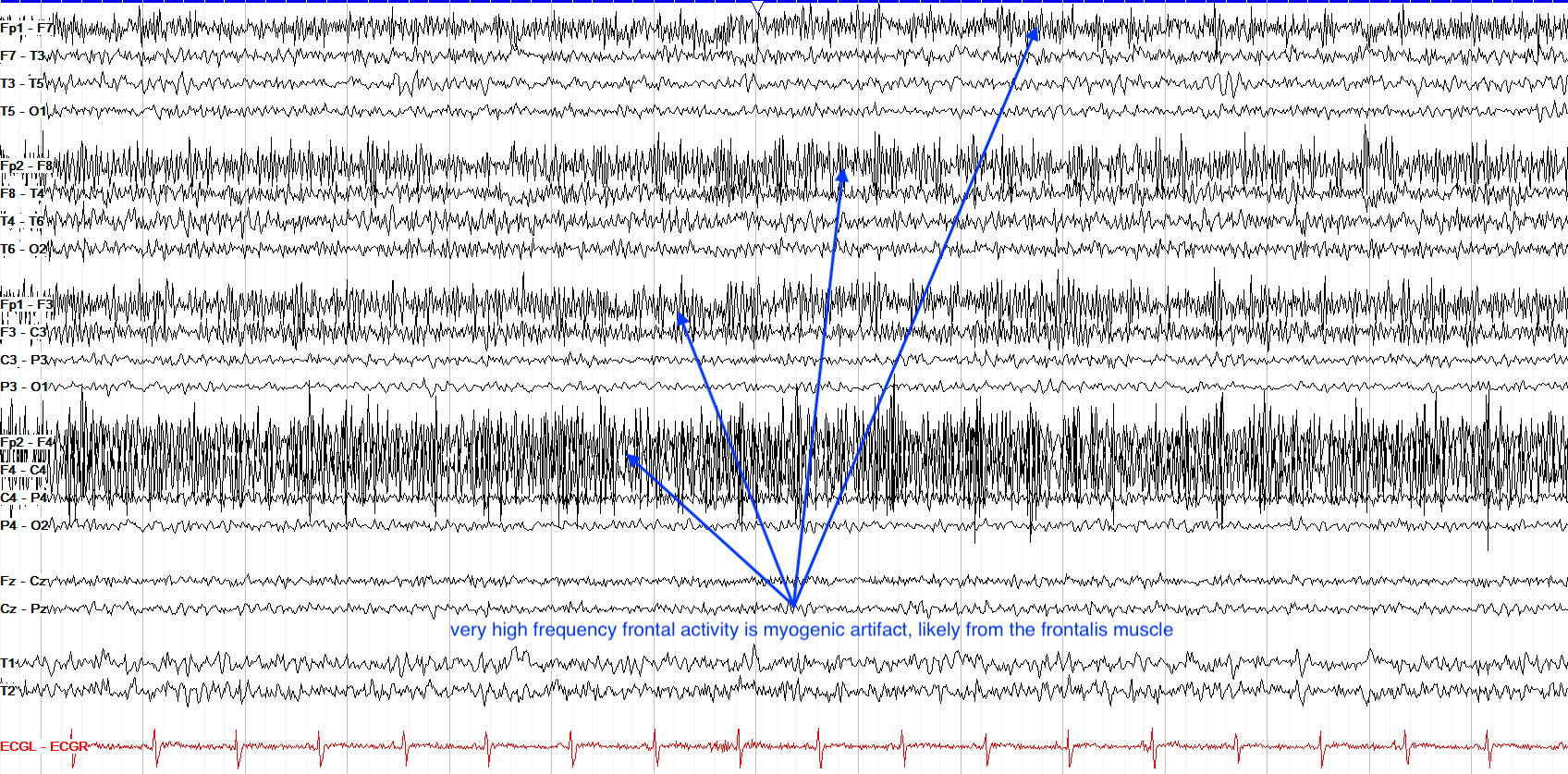 BME EEG Analysis Preprocessing Aursus