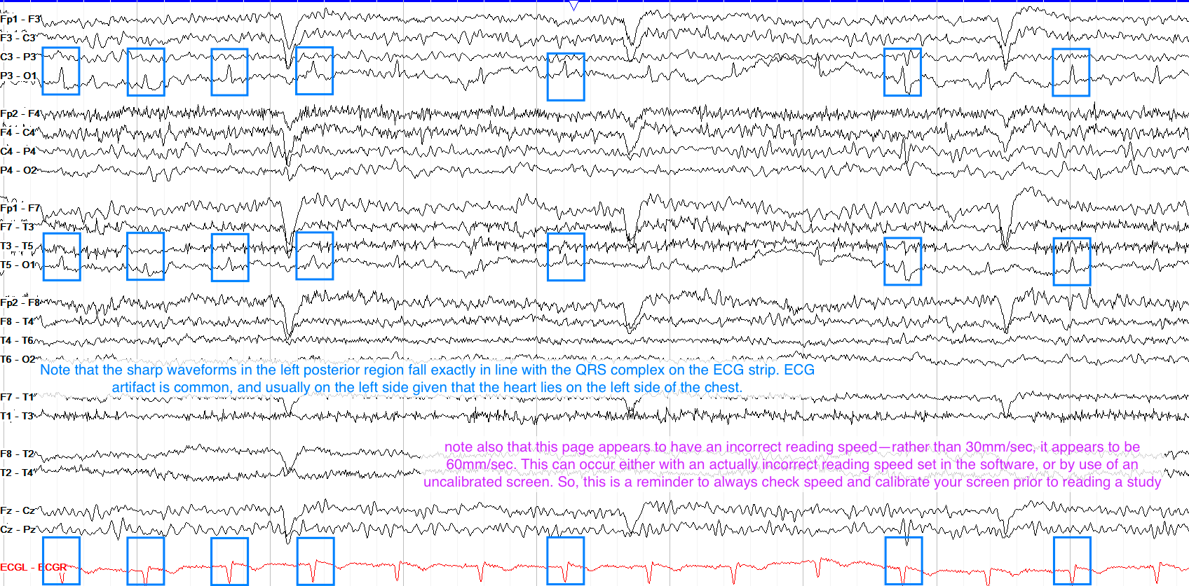 BME EEG Analysis Preprocessing Aursus