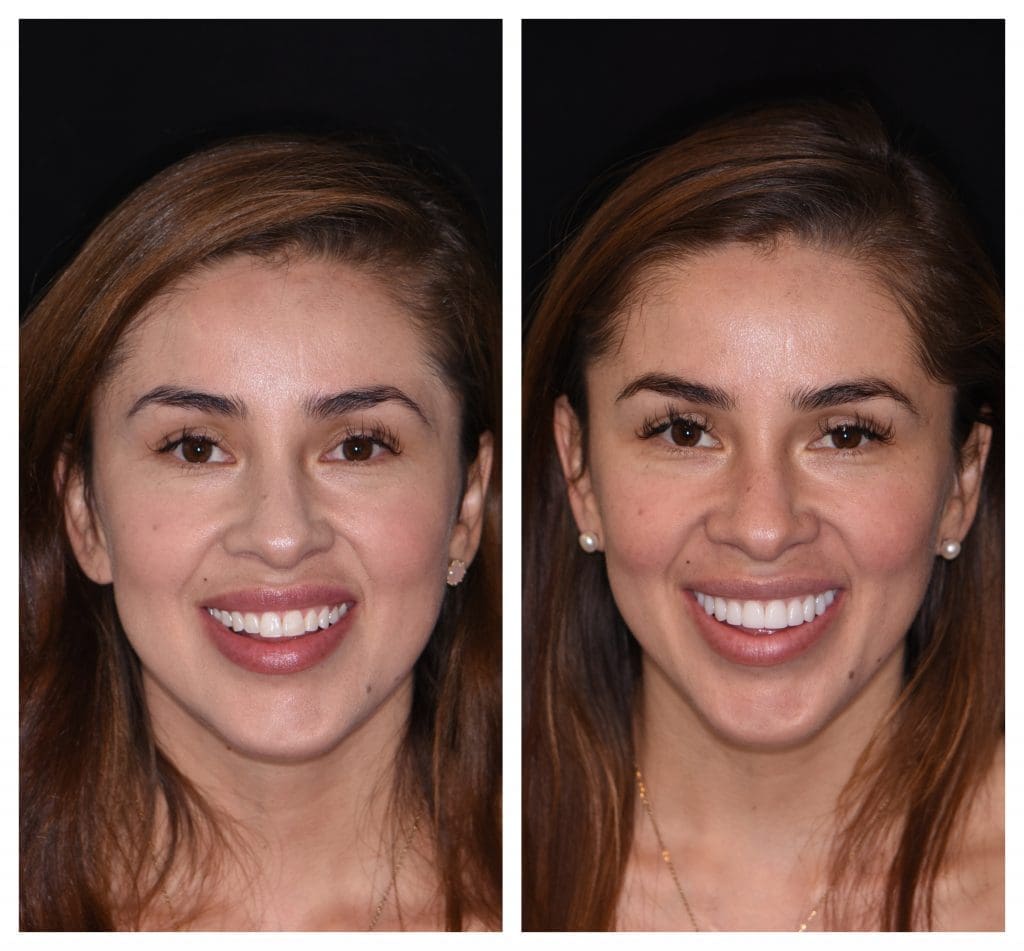 Minimal Prep / No Prep Veneers Austin Cosmetic Dentistry By Tejas
