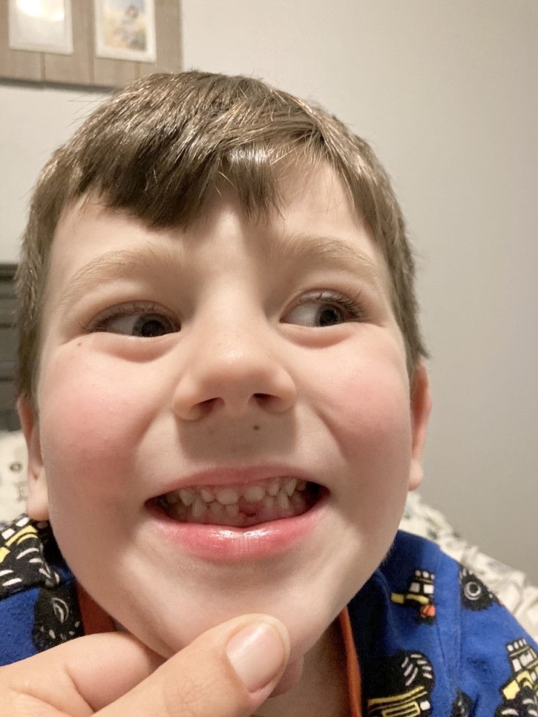 Pulling Baby Teeth When and How? Austin Dental Group