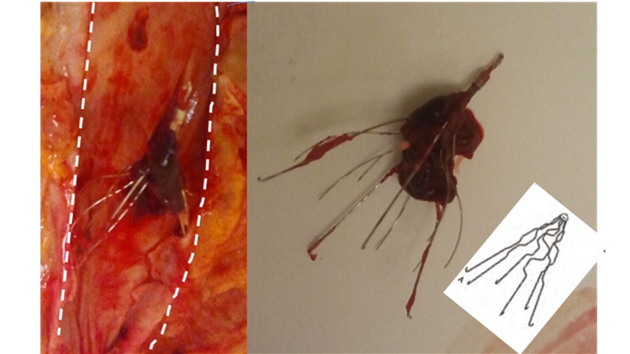 Monthly Case Greenfield filter with clot Autopsy Center of Chicago