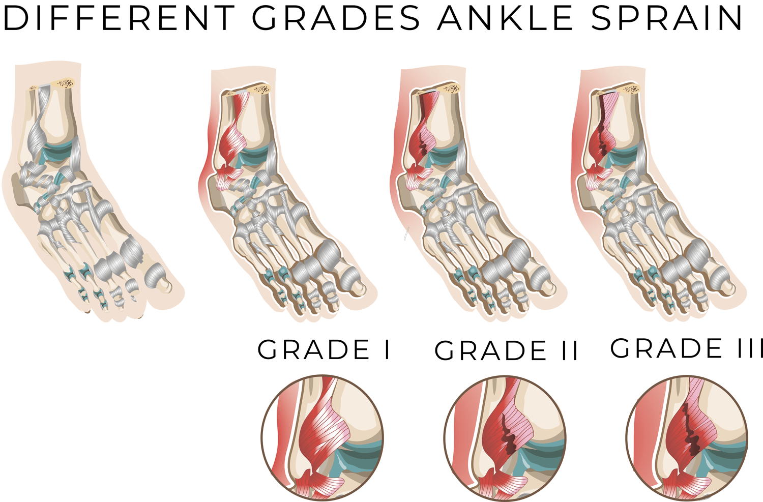 SPRAINS AND STRAINS AVALA