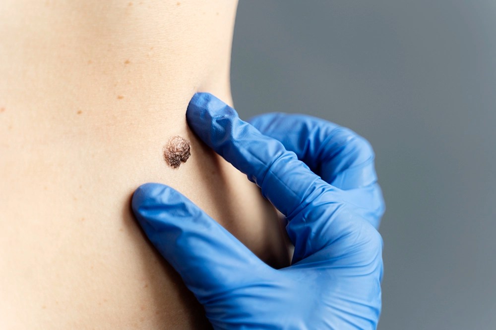 How Much Does Mole Removal Cost? Aventus Clinic