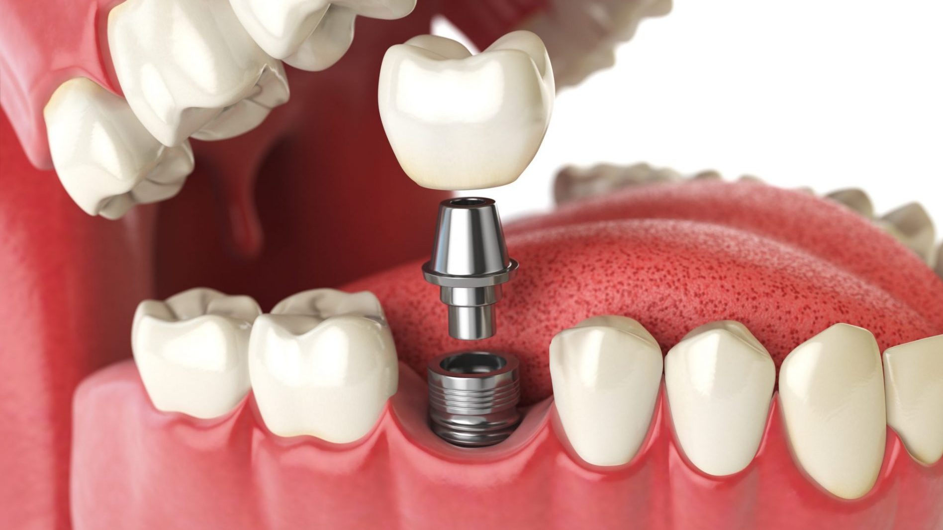 Dental Implants Philadelphia, PA Avenue Smiles