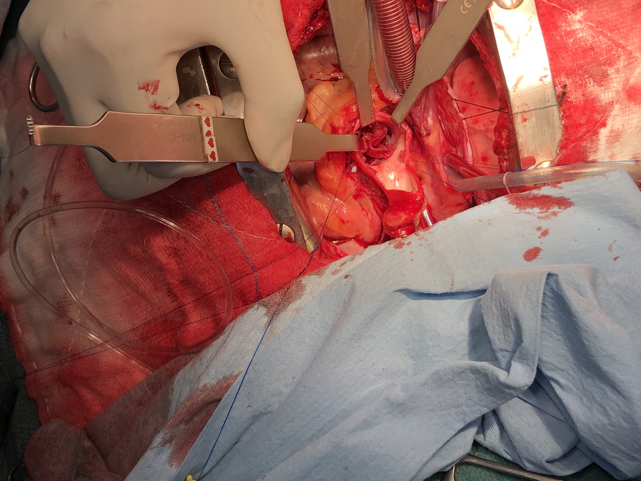 Training at Penang General Hospital AVNeo