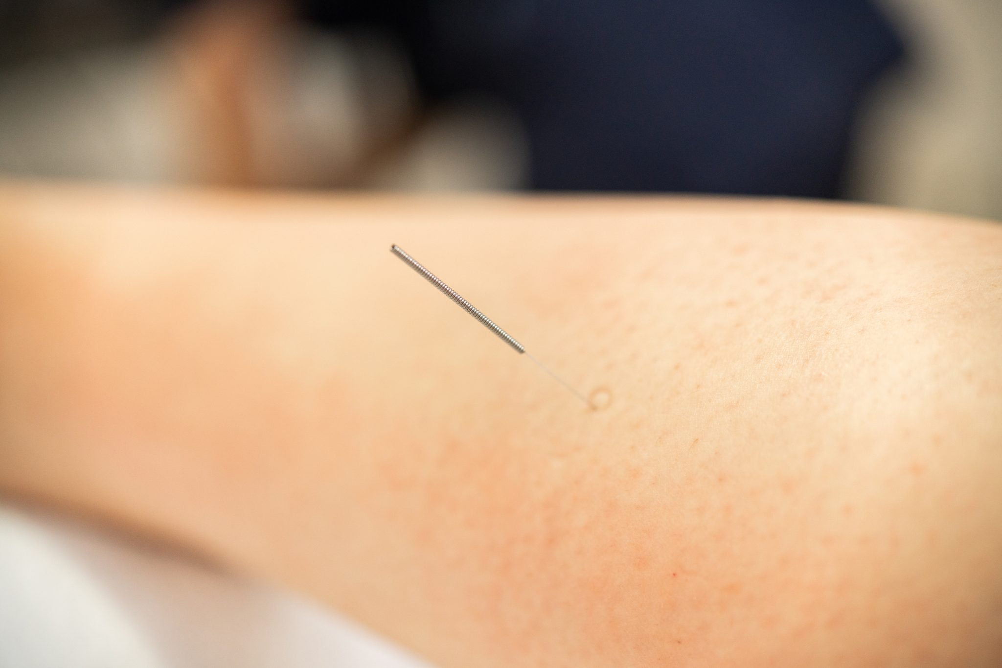 What Is Dry Needling? Awaken Chiropractic