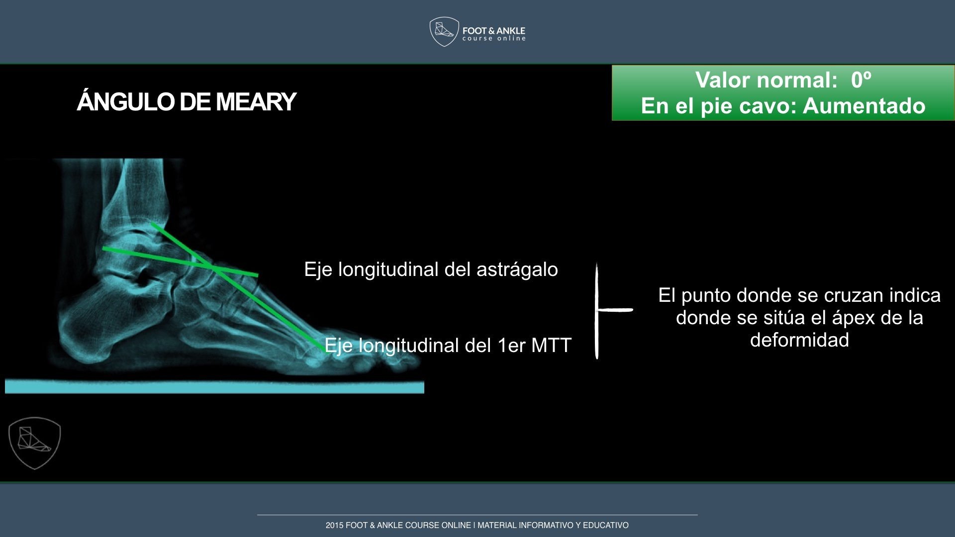 Medición angular en el estudio del pie cavo varo aware.doctor