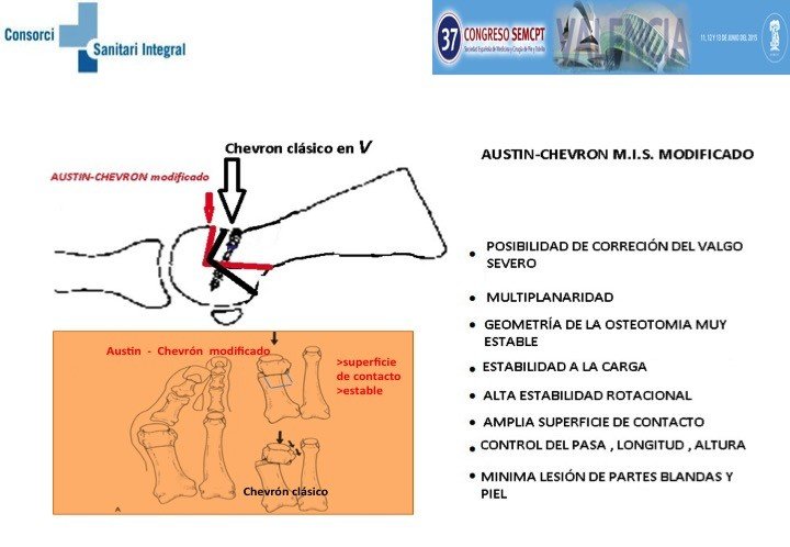 Chevron cirugía mínimamente invasiva Hallux Valgus aware.doctor