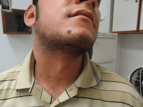 Malignant Peripheral Nerve Sheath Tumor of Neck A Case Report