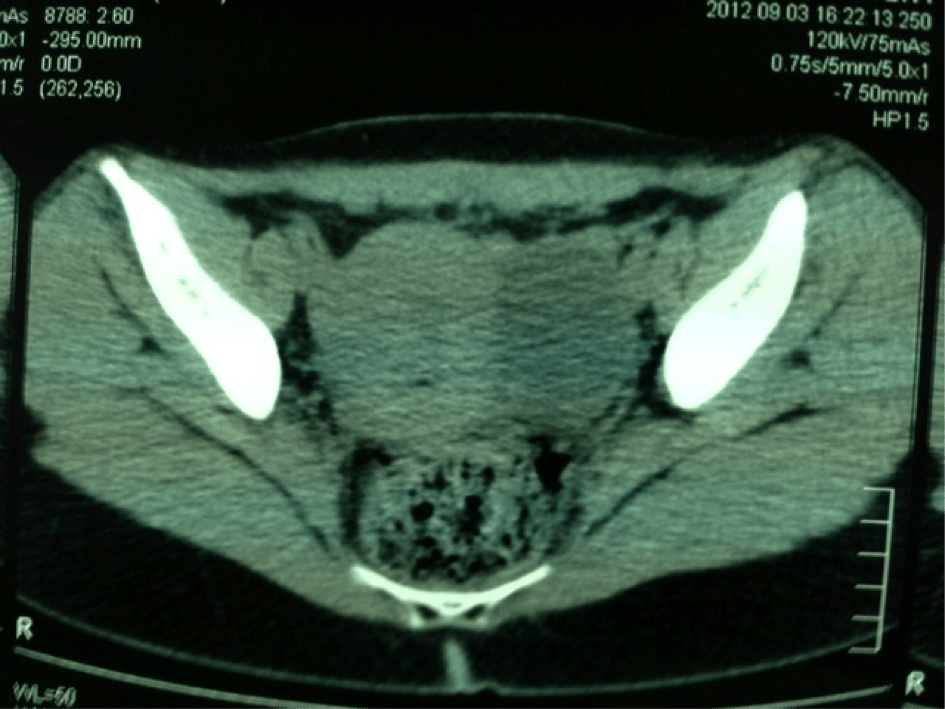 Cancérisation d’un kyste dermoide de l’ovaire à propos d’un cas